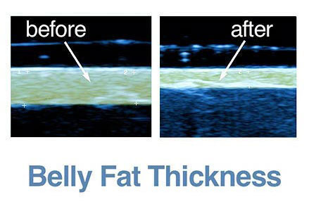 How Does the Tummy Tuck Cream Work?